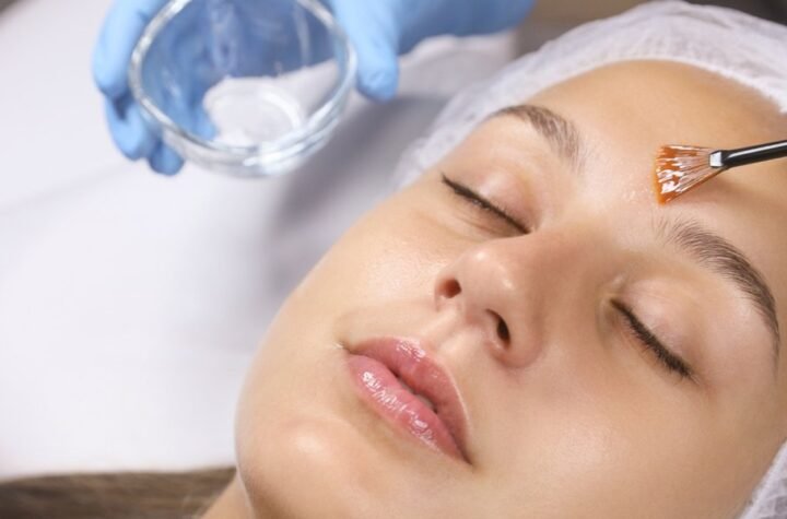 Chemical Peels