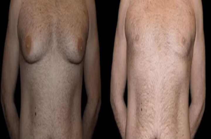 Before and After Male Breast Reduction Results