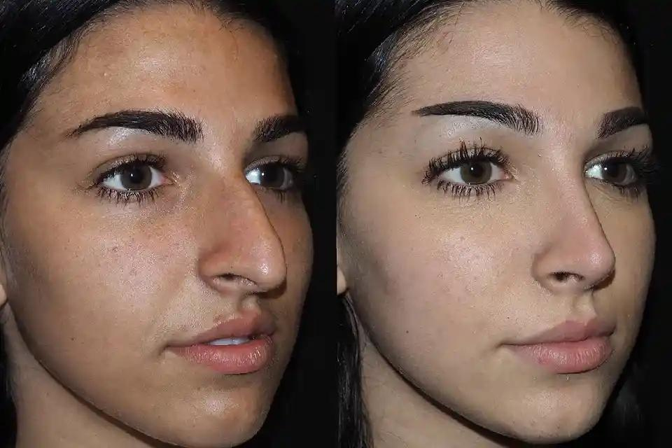 rhinoplasty in dubai