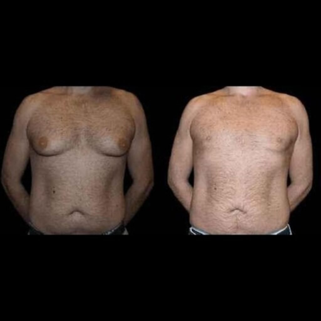 Before and After Male Breast Reduction Result