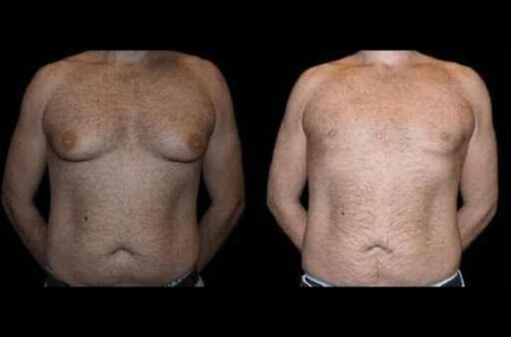 Before and After Male Breast Reduction Result