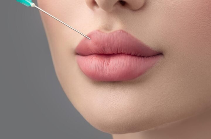 Russian Lip Fillers in Dubai