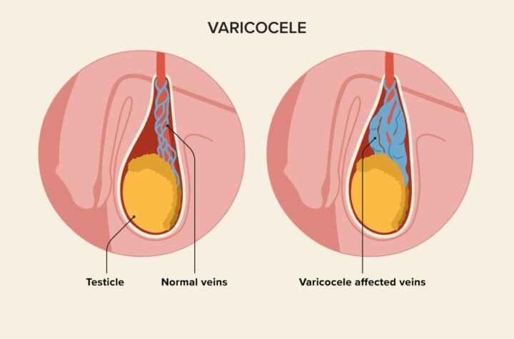 Scrotal swelling